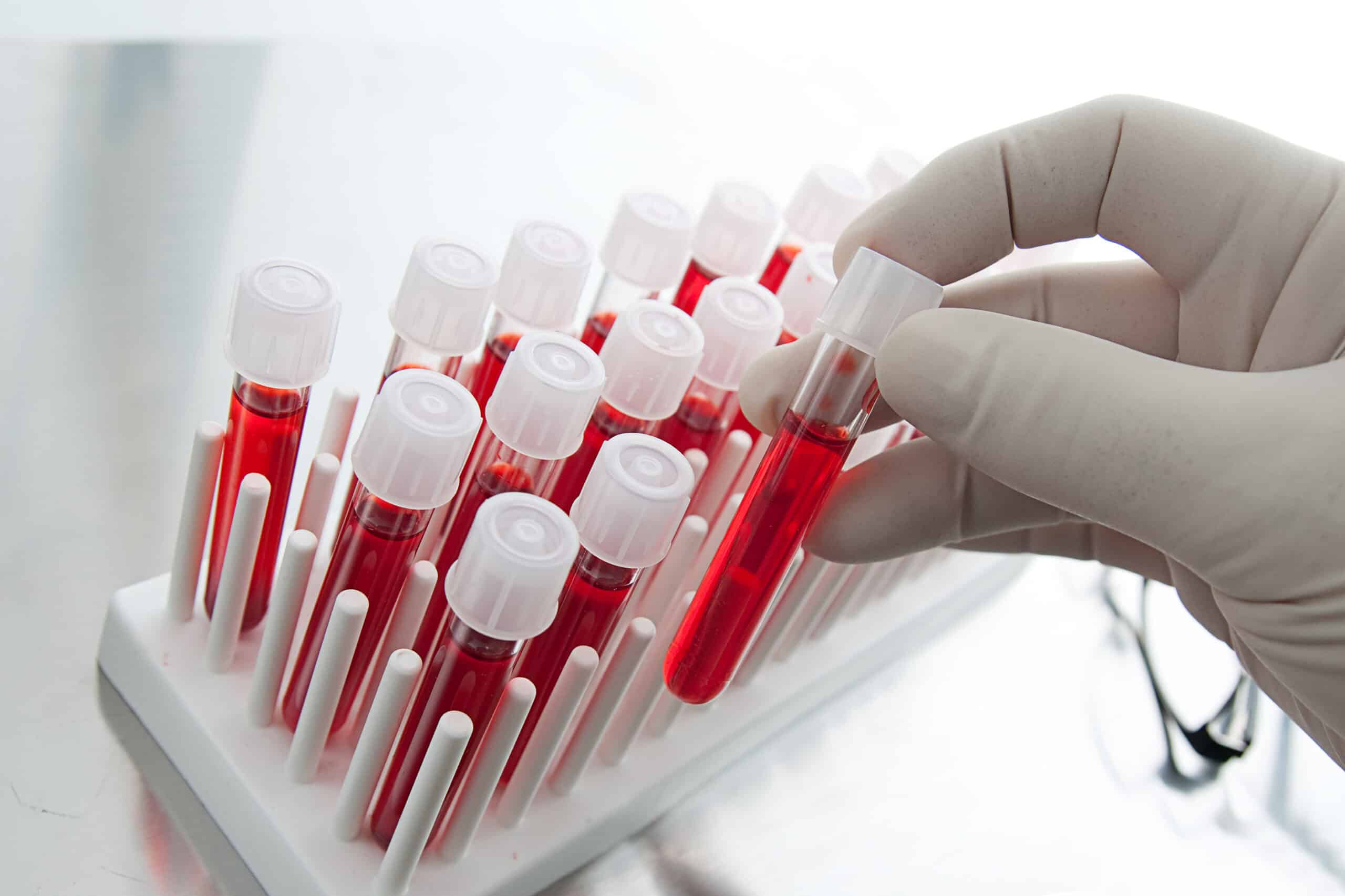 Researchers improve blood tests’ ability to detect and monitor cancer
