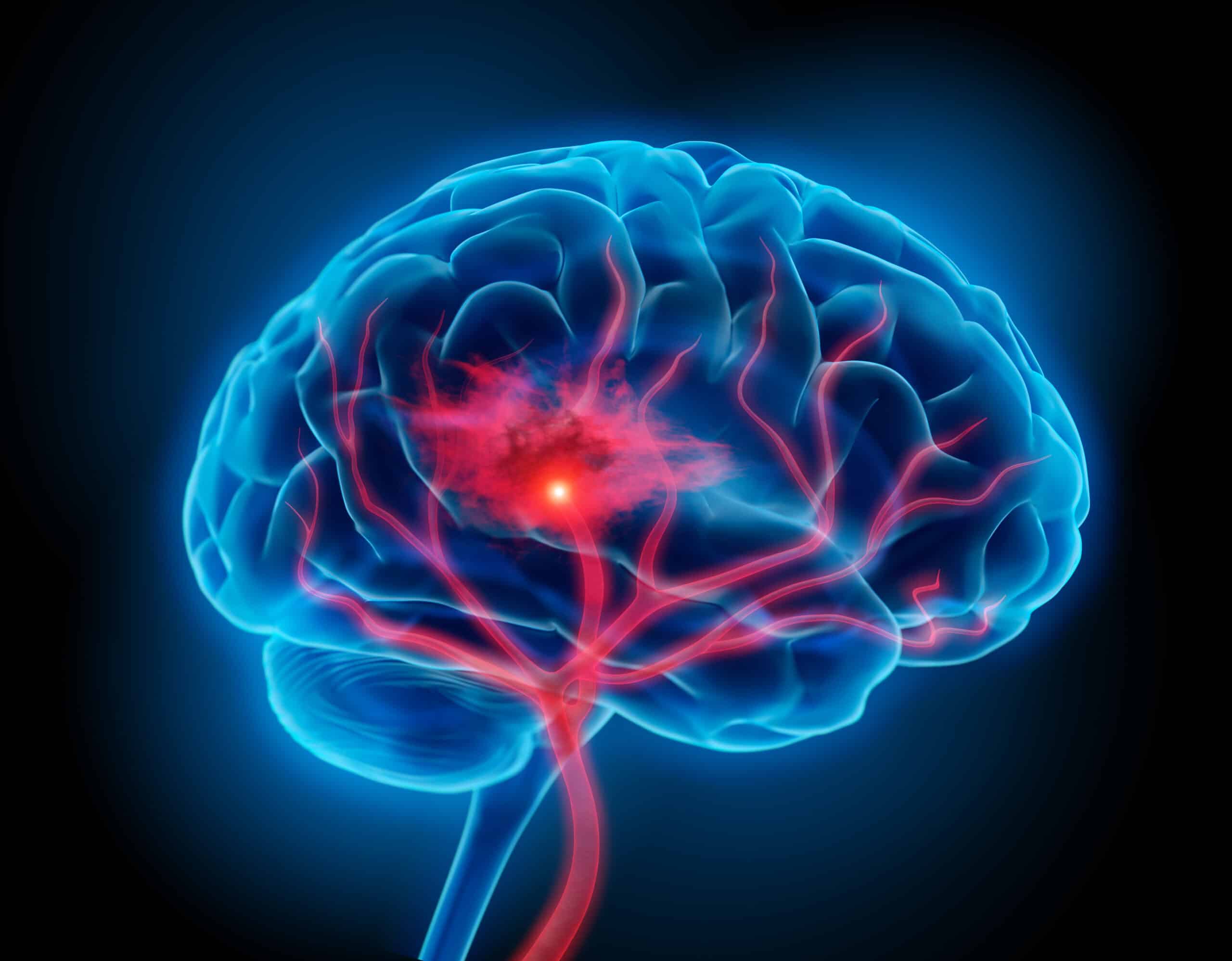 Deep Brain Stimulation Shows Benefit For Stroke Survivors